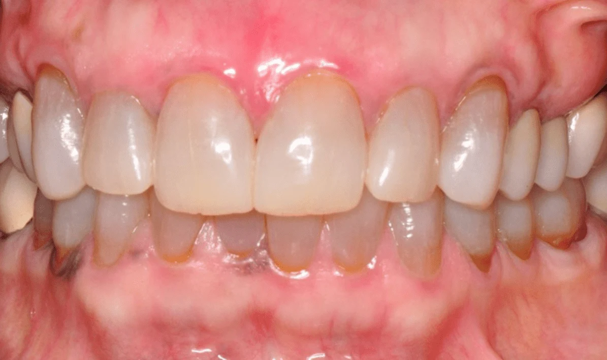 Before and After images for Depigmentation of Gingiva