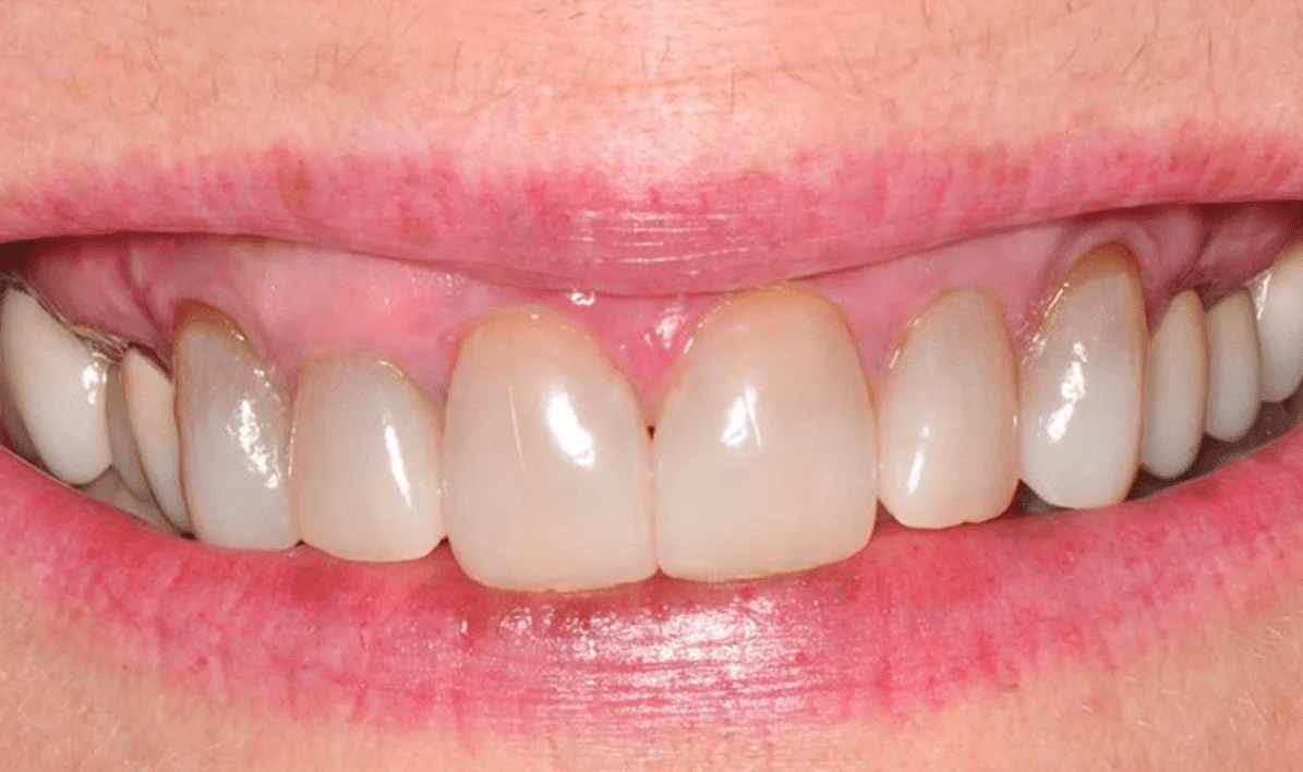 Before and After images for Depigmentation of Gingiva