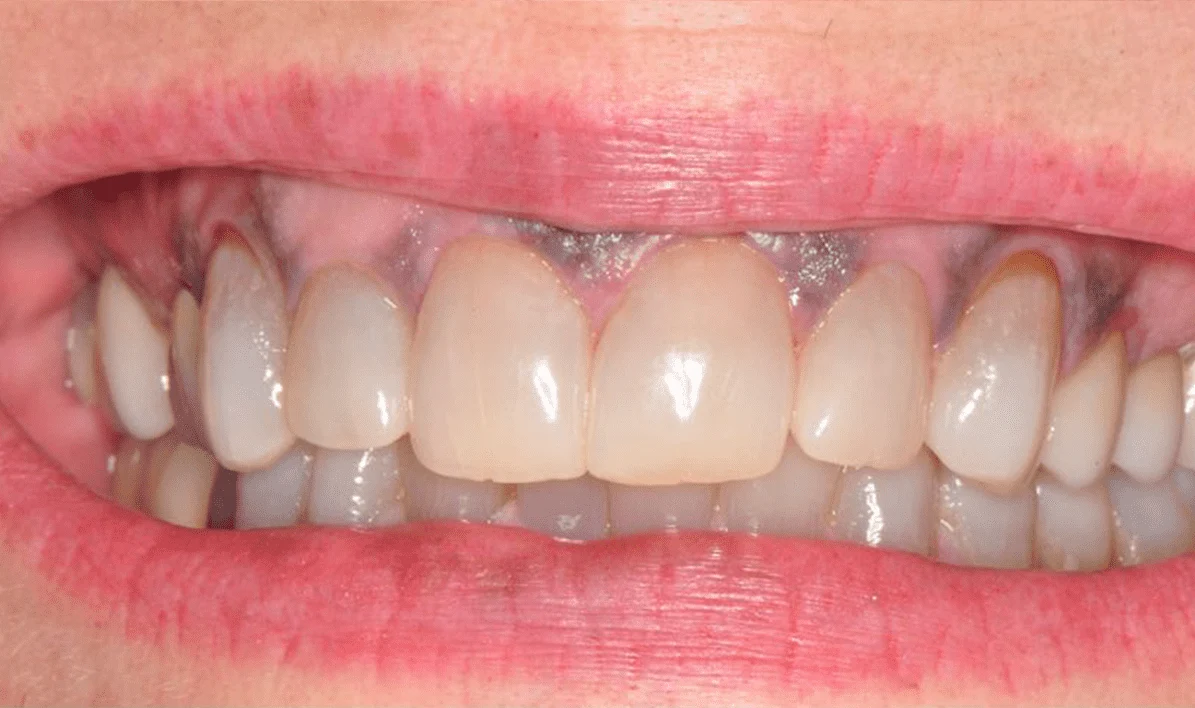 Before and After images for Depigmentation of Gingiva